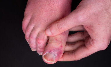 COVID TOES: Eksempel på det som har blitt beskrevet som "Covid toes". Blåmerke liknende flekker på tærne - hyppigst observert hos yngre pasienter. FOTO: Scanpix NTB / Shutterstock / Chris Curry COVID TOES: Eksempel på det som har blitt beskrevet som "Covid toes". Blåmerke liknende flekker på tærne - hyppigst observert hos yngre pasienter. FOTO: Scanpix NTB / Shutterstock / Chris Curry